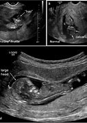 Image result for Anencephaly Fetal Brain Ultrasound