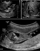 Image result for Anencephaly On Ultrasound