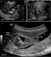 Image result for Anencephaly Sagittal Section On Ultrasound