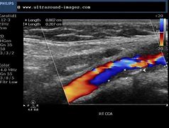 Image result for Carotid Stenosis Ultrasound