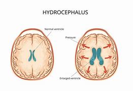 Image result for Hydrocephalus
