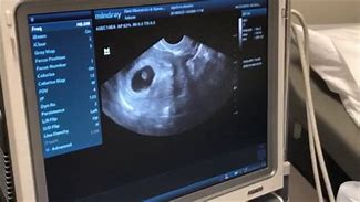 Image result for Baby Ultrasound at 6 Weeks