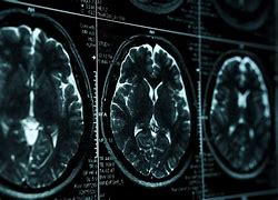 Image result for Anoxic Brain Injury