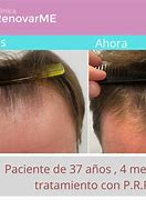 Image result for alopeciq