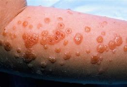 Image result for Gingival Erythema