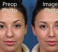 Image result for Bulbous Tip Rhinoplasty