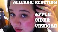 Image result for Apple Cider Allergy