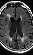 Image result for Age Spots On Brain