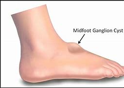Image result for Midfoot Ganglion Cyst