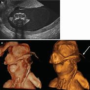 Image result for Pathology Anencephaly