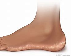 Image result for Moccasin Athlete's Foot