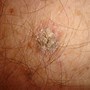 Image result for Actinic Solar Keratosis