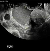 Image result for Ovarian Dermoid Picture On US