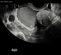Image result for Dermoid Cyst Ultrasound