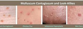 Image result for Molluscum Contagiosum Treatment Bakersfield