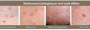 Image result for Molluscum Stages of Healing