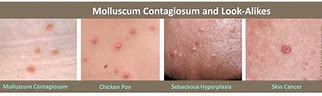 Image result for Molluscum Contagiosum vs Chicken Pox