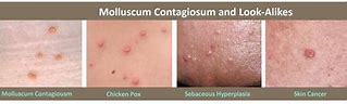 Image result for Molluscum Contagiosum On Black Skin