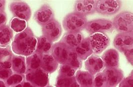 Image result for Gonorrhea Pics