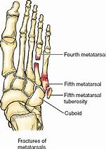 Image result for 5th Metatarsal Tuberosity Fracture