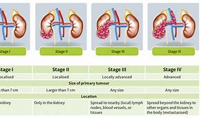 Image result for Kidney Cancer Staging