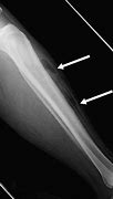 Image result for Gas Leg CT