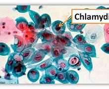 Image result for Chlamydia Symptoms Images