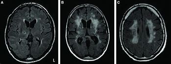 Image result for WMH MRI