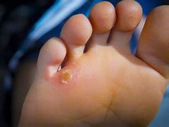 Image result for Infected Corn On Foot