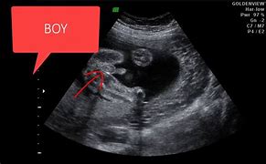 Image result for Ultrasound at 13 Weeks Pregnant