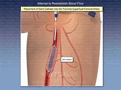 Image result for Stent Procedure through Groin