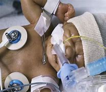 Image result for Intubated Patients ICU