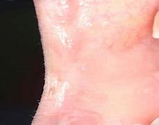 Image result for Excision Condyloma