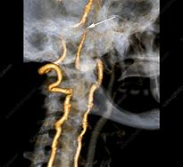 Image result for Vertebral Artery Insufficiency