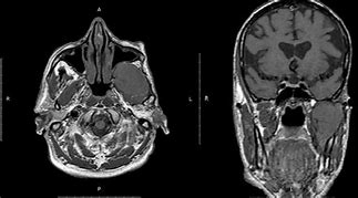 Image result for Infratemporal Fossa Tumors