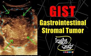 Image result for Gist Tumor Locations