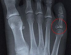 Image result for Broken Toe X-rays