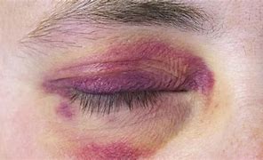 Image result for Beat Up Eye