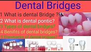 Different types of dental bridges ( zee dental chanel ) dental bridges//what is dental bridge