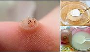 How to Get Rid of Warts Naturally