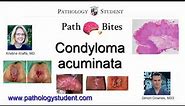 Path Bites - Condyloma Acuminata