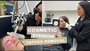 Cosmetic Eyebrow Tattoo Removal with LaserTat