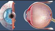 Cataract Surgery | Inside the OR