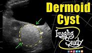 Dermoid Cyst || Ultrasound || Case 164