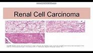 Renal cell carcinoma: Types,Genetics,Morphology