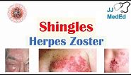 Shingles (Herpes Zoster): Pathophysiology, Risk Factors, Phases of Infection, Symptoms, Treatment