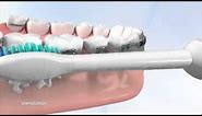 Tips on how use a Philips Sonicare toothbrush with braces. Hygiene is a key part of daily care.