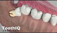 Impacted Tooth Removal