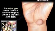 Ganglion Cyst Wrist - Everything You Need To Know - Dr. Nabil Ebraheim