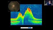 OCT in Neuro ophthalmic Disorders